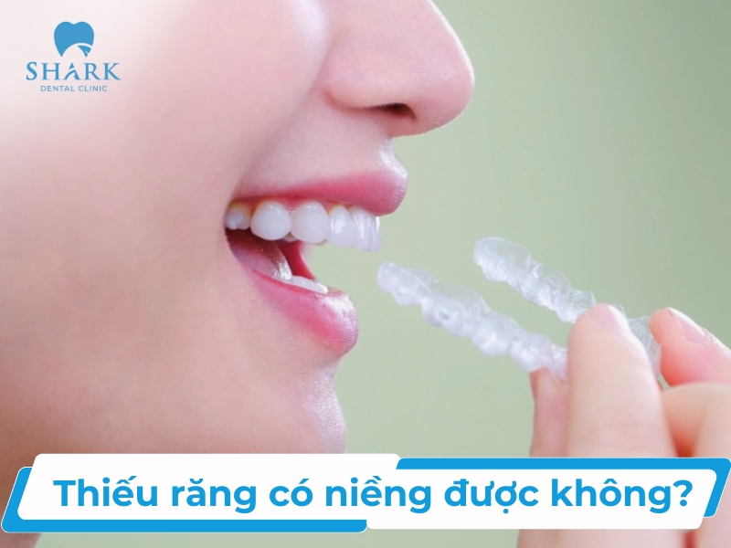 Thiếu răng có niềng được không? Niềng bằng phương pháp nào?
