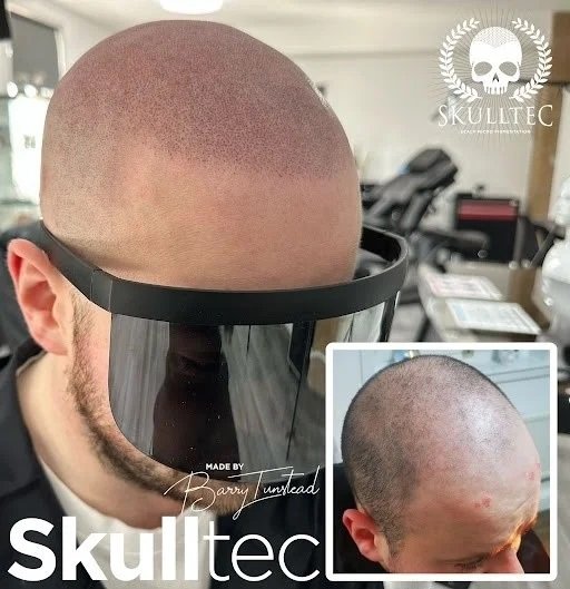 What Is the Recovery Time After Scalp Micropigmentation London?