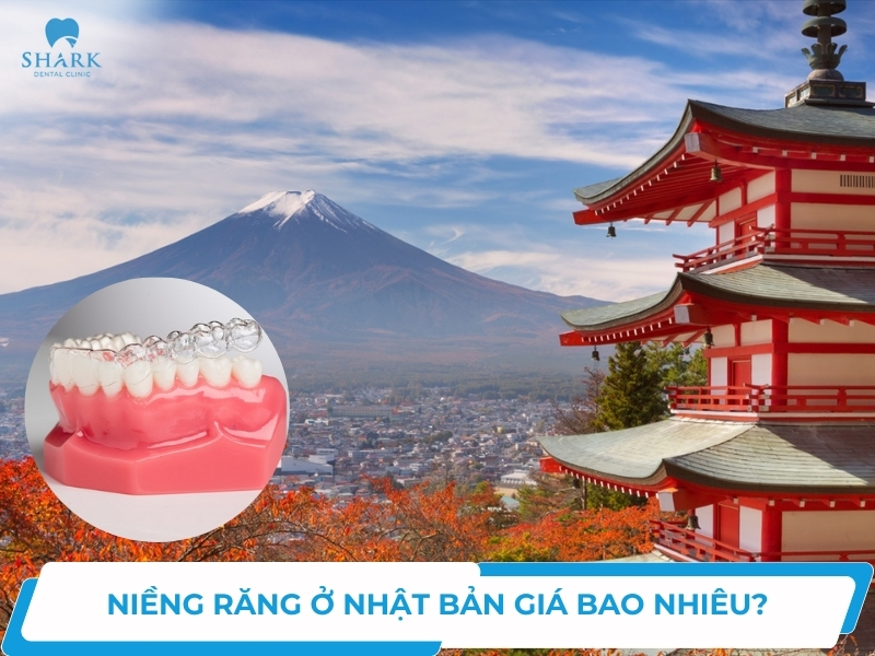 Chi phí niềng răng ở Nhật giá bao nhiêu? Có tốt không?