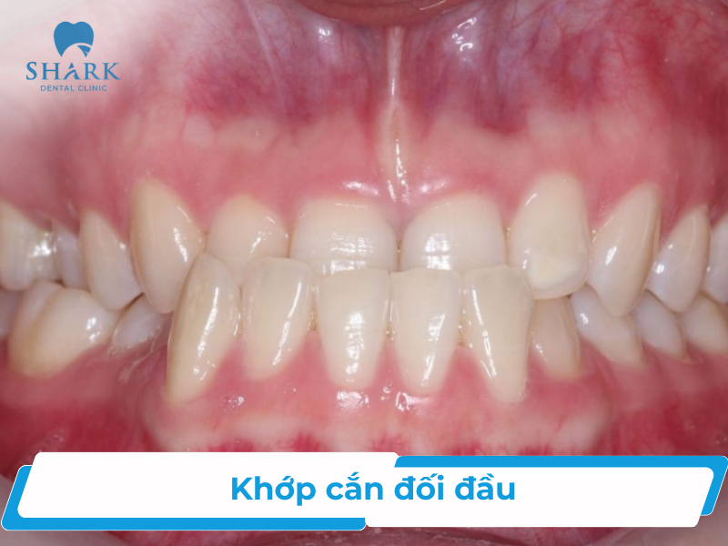 Khớp cắn đối đầu là gì? Nguyên nhân và cách khắc phục