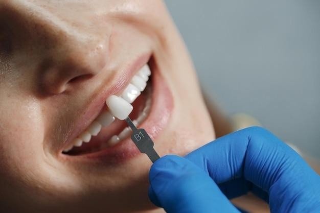 The Necessary Facts to Know About Dental Lumineers Veneers in Ottawa- Tube Galore