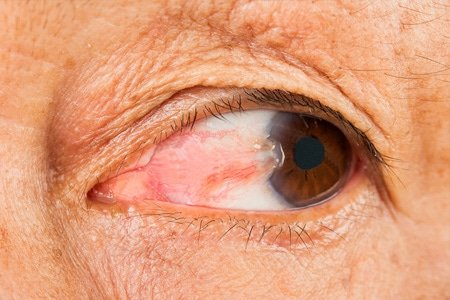 Common Eye Conditions Treated with Laser Technology - Blog Buz