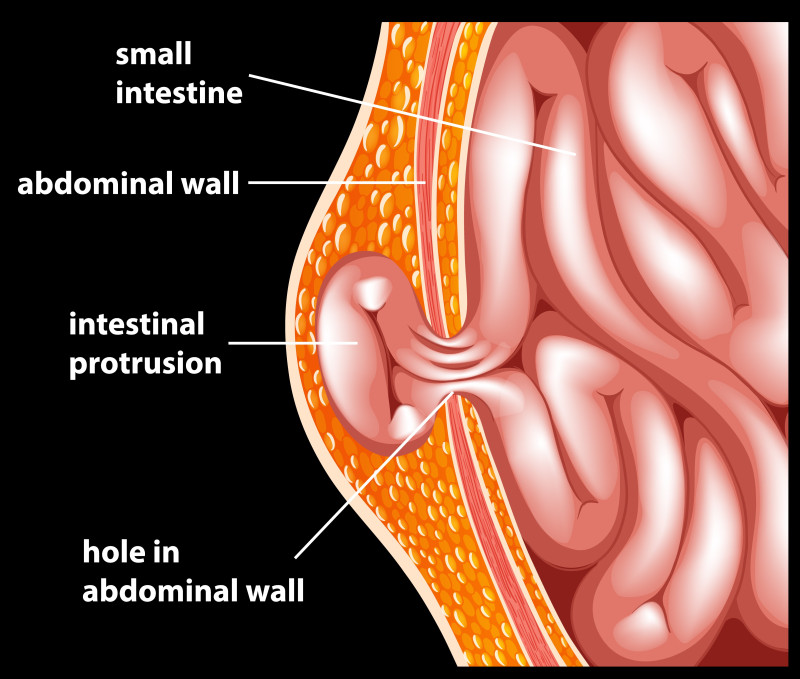 Best Doctors for Incisional Hernia: Reviews & Recommendations