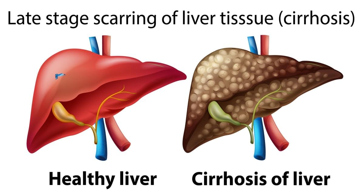 Liver Cirrhosis Explained: Early Signs You Shouldn’t Ig...