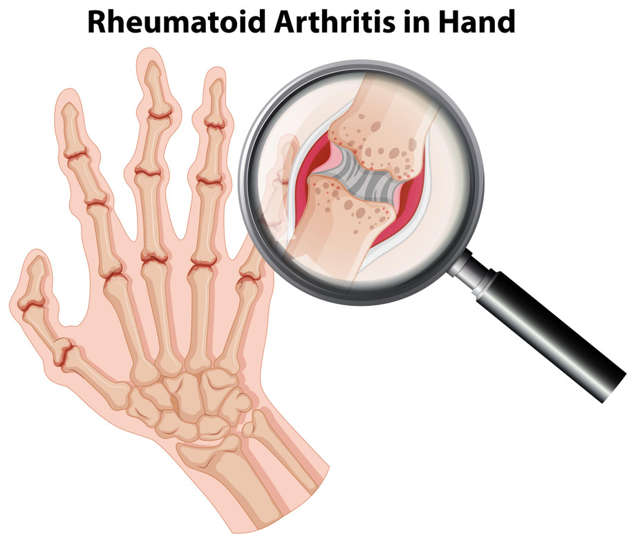Living with Rheumatoid Arthritis: Tips for Daily Management - JustPaste.it