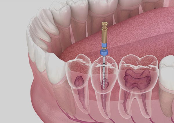 Root Canal Treatment in RR Nagar. One of the most common dental… | by Symphonysmiles | Jul, 2025 | Medium
