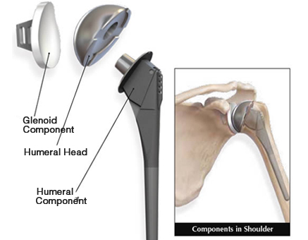 Shoulder Replacement Surgeon in Faridabad | Noida | Ghaziabad