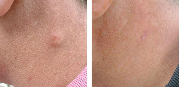 Best Reasons To See An Affordable Dermatologist London For Removing Sebaceous Cyst - Pogeo.co.uk