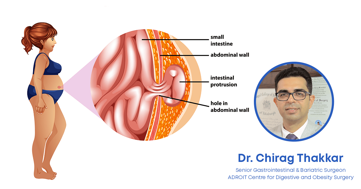 Large, Complex, and Recurrent Incisional Hernia: Causes, Challenges & Treatment Options