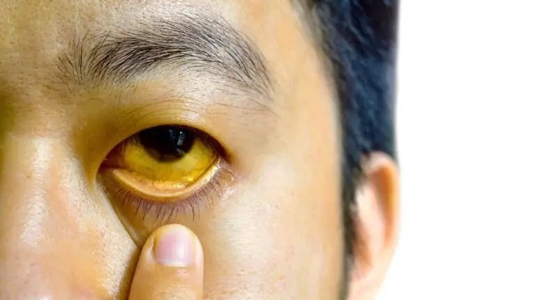 Yellow Eyes: What It Means and How to Treat It