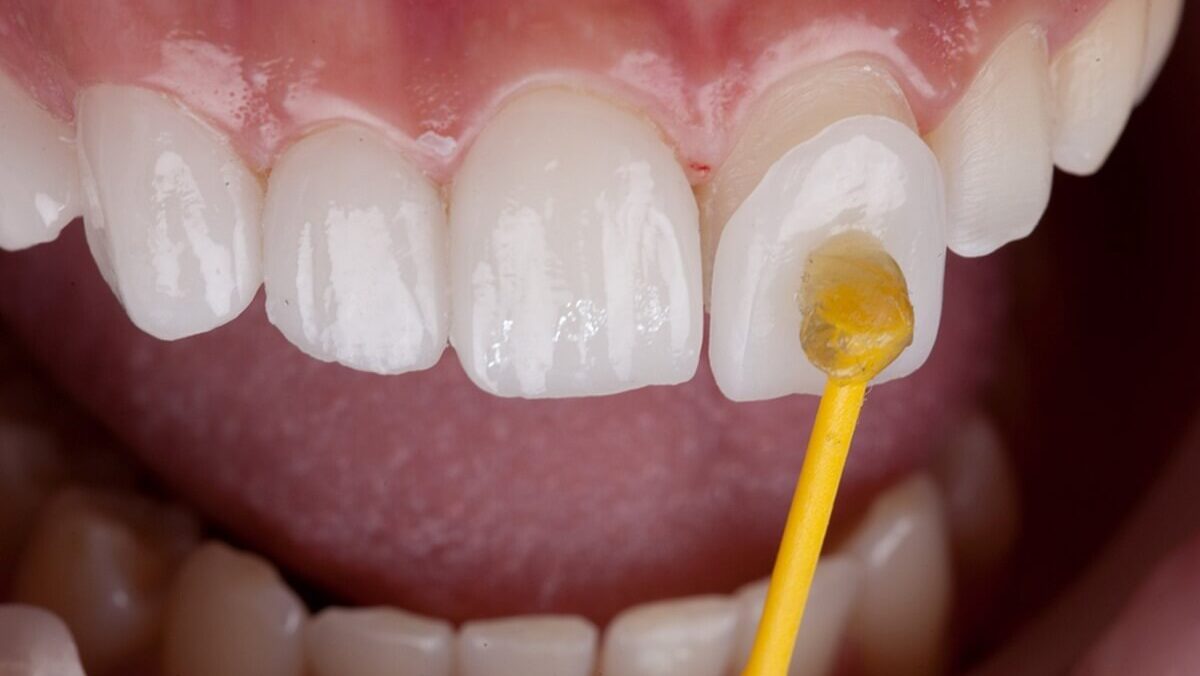 Being Familiar About the Process of Dental Veneers in Ottawa, Canada