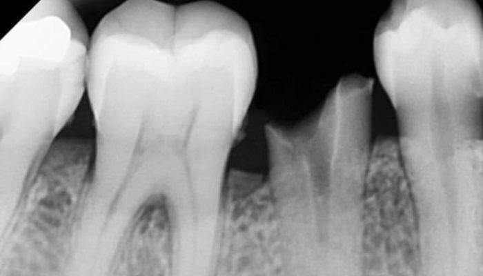 Best Dental Implants Clinic in Madhapur | Olive's Dental World