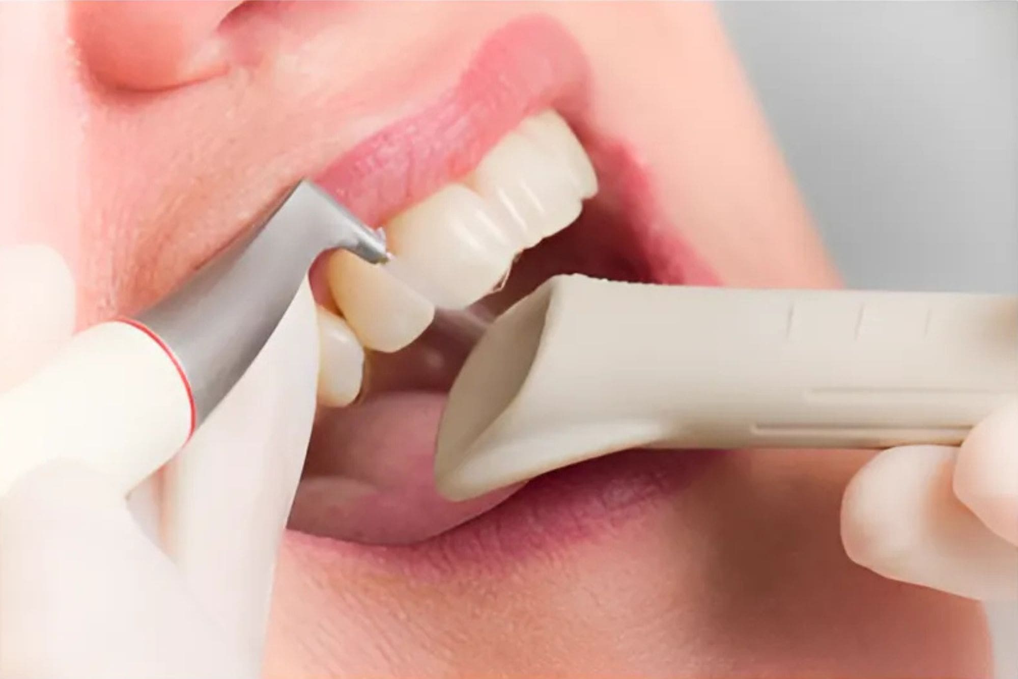 Teeth Scaling Damansara Uptown | Gentle Deep Cleaning Care