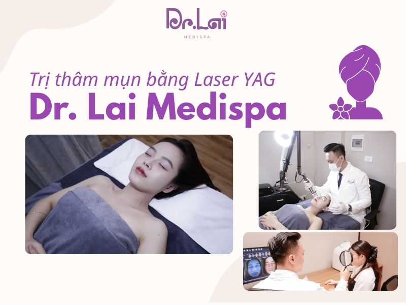 Trị thâm mụn bằng phương pháp Laser YAG bao lâu có hiệu quả?