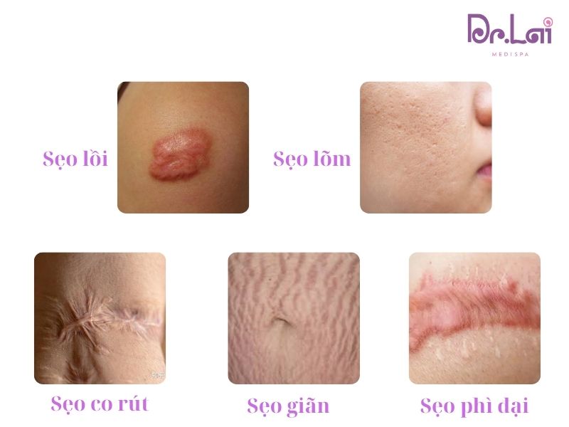 Cắt đáy sẹo rỗ giá bao nhiêu? Phương pháp nào tốt nhất hiện nay