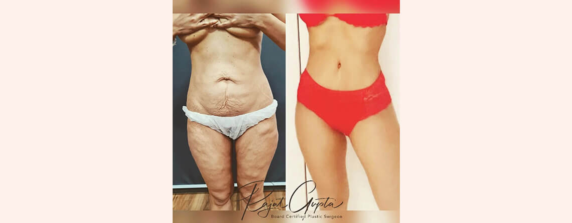 Tummy Tuck Surgery in Delhi for Skin Removal