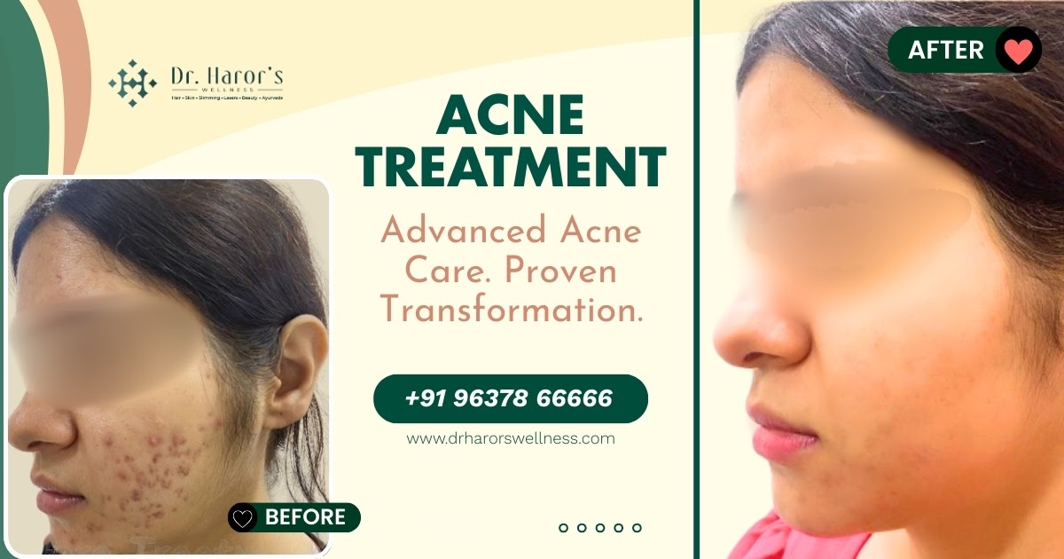 Clinical ACNE Treatments That Deliver Results